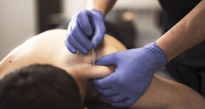 Punción Seca: Una Técnica Eficaz para el Dolor Muscular
